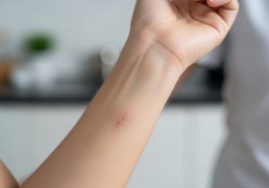 ăn nước mắm có để lại sẹo không